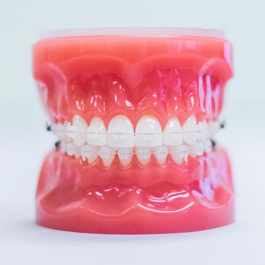 clear braces on plastic model