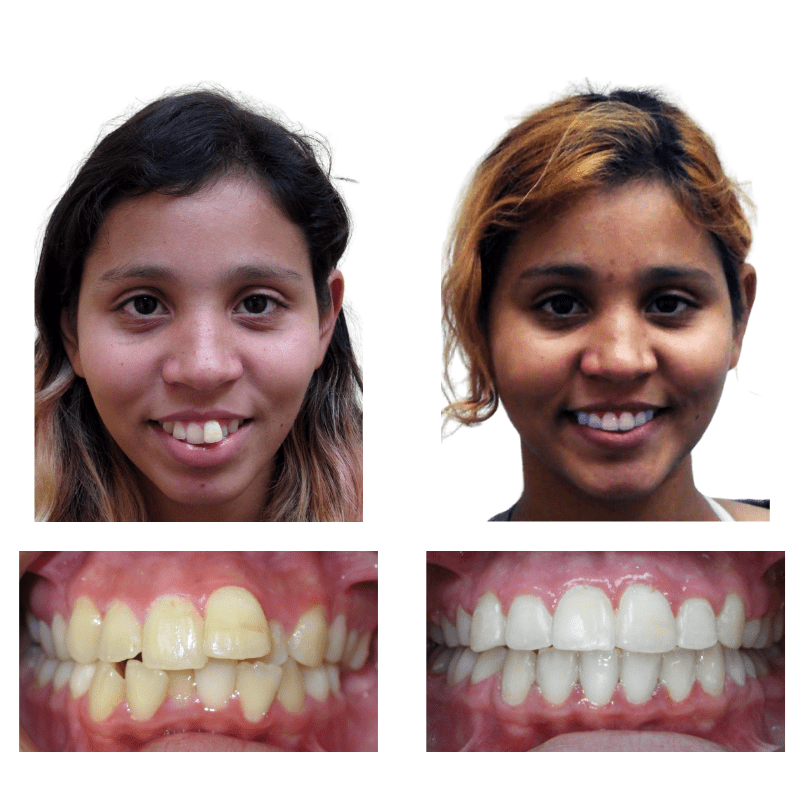 angie-matute-beforeafter