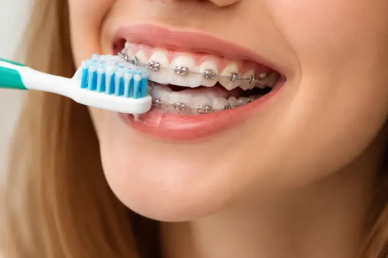 How to Brush Teeth With Braces