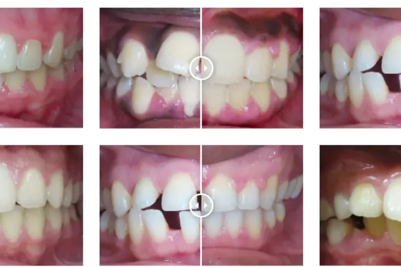 orthodontic braces before and after