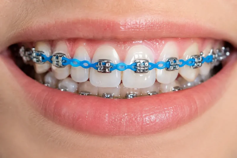 colored power chain connecting brackets across the upper teeth